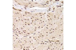 Immunohistochemistry of paraffin-embedded Human gastric cancer using RBPJ antibody at dilution of 1:100 (x40 lens).