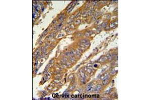 PAN3 Antibody IHC analysis in formalin fixed and paraffin embedded human cervix carcinoma followed by peroxidase conjugation of the secondary antibody and DAB staining. (PAN3 Antikörper  (C-Term))
