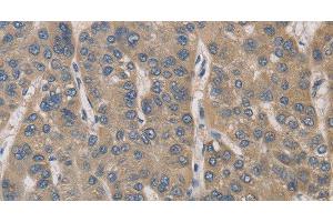 Immunohistochemistry of paraffin-embedded Human liver cancer tissue using IRAK4 Polyclonal Antibody at dilution 1:40 (IRAK4 Antikörper)