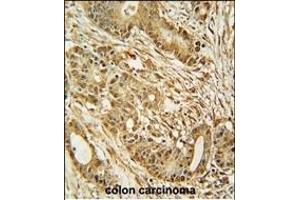 MCM2 Antibody (C-term) (ABIN653324 and ABIN2842815) immunohistochemistry analysis in formalin fixed and paraffin embedded human colon carcinoma followed by peroxidase conjugation of the secondary antibody and DAB staining.