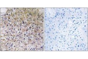 Immunohistochemistry analysis of paraffin-embedded human breast carcinoma tissue, using ATP6V1B1 Antibody.