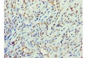Immunohistochemistry of paraffin-embedded human breast cancer using ABIN7145241 at dilution of 1:100 (BBS4 Antikörper  (AA 350-519))