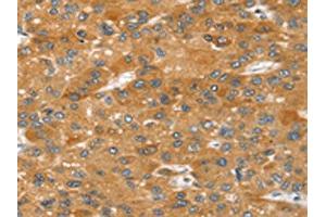 The image on the left is immunohistochemistry of paraffin-embedded Human liver cancer tissue using ABIN7192646(SRGAP2 Antibody) at dilution 1/20, on the right is treated with synthetic peptide. (SRGAP2 Antikörper)