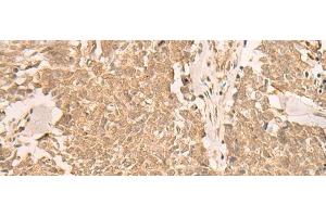Immunohistochemistry of paraffin-embedded Human lung cancer tissue using IL1RAPL2 Polyclonal Antibody at dilution of 1:25(x200) (IL1RAPL2 Antikörper)