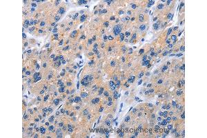Immunohistochemistry of Human gastric cancer using TNFRSF9 Polyclonal Antibody at dilution of 1:40 (CD137 Antikörper)