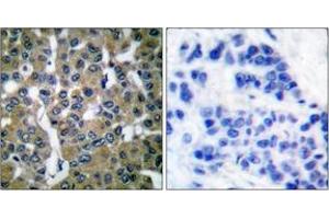 Immunohistochemistry analysis of paraffin-embedded human breast carcinoma tissue, using PLCG2 (Ab-753) Antibody. (Phospholipase C gamma 2 Antikörper  (AA 721-770))