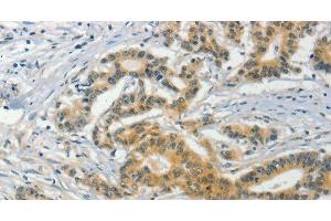 Immunohistochemistry of paraffin-embedded Human colon cancer tissue using ASB8 Polyclonal Antibody at dilution 1:50 (ASB8 Antikörper)