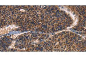 Immunohistochemistry of paraffin-embedded Human liver cancer using CD61 Polyclonal Antibody at dilution of 1:30 (Integrin beta 3 Antikörper)