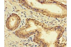 Immunohistochemistry of paraffin-embedded human prostate cancer using ABIN7165398 at dilution of 1:100 (FAM135B Antikörper  (AA 801-1100))