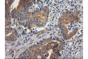 Immunohistochemical staining of paraffin-embedded Adenocarcinoma of Human colon tissue using anti-BCAR1 mouse monoclonal antibody. (BCAR1 Antikörper)