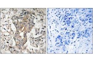 Immunohistochemistry analysis of paraffin-embedded human breast carcinoma tissue, using SPHK2 (Ab-614) Antibody. (SPHK2 Antikörper  (AA 580-629))
