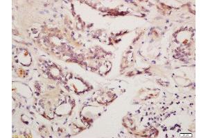 Formalin-fixed and paraffin embedded human breast cancer labeled with Rabbit Anti-GnRHR Polyclonal Antibody, Unconjugated  at 1:200, followed by conjugation to the secondary antibody and DAB staining