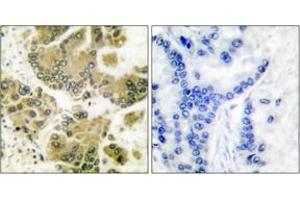 Immunohistochemistry analysis of paraffin-embedded human breast carcinoma tissue, using SGK (Ab-422) Antibody. (SGK1 Antikörper  (AA 381-430))