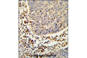 Formalin-fixed and paraffin-embedded human lung carcinoma reacted with SH2D1B Antibody , which was peroxidase-conjugated to the secondary antibody, followed by DAB staining.