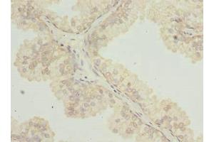 Immunohistochemistry of paraffin-embedded human prostate cancer using ABIN7171939 at dilution of 1:100 (TTC38 Antikörper  (AA 2-200))