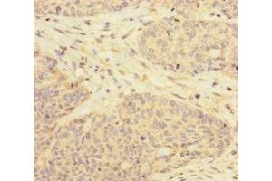 Immunohistochemistry of paraffin-embedded human ovarian cancer using ABIN7170629 at dilution of 1:100 (RBM17 Antikörper  (AA 1-240))