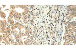 Immunohistochemistry of paraffin-embedded Human gastric cancer using TRPM5 Polyclonal Antibody at dilution of 1:60 (TRPM5 Antikörper)