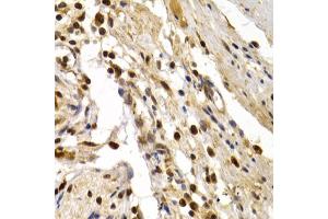 Immunohistochemistry of paraffin-embedded human colon damage using DP1/DP1/TFDP1 antibody (ABIN6130313, ABIN6149038, ABIN6149040 and ABIN6221075) at dilution of 1:200 (40x lens). (DP1 Antikörper  (AA 1-290))