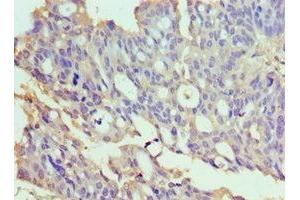 Immunohistochemistry of paraffin-embedded human endometrial cancer using ABIN7172022 at dilution of 1:100 (TXNRD2 Antikörper  (AA 100-310))