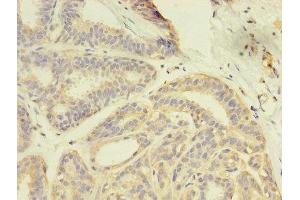 Immunohistochemistry of paraffin-embedded human breast cancer using ABIN7166957 at dilution of 1:100 (GDI2 Antikörper  (AA 1-445))