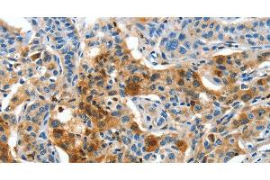 Immunohistochemistry of paraffin-embedded Human lung cancer tissue using COG1 Polyclonal Antibody at dilution 1:60 (COG1 Antikörper)