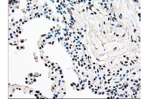 Immunohistochemical staining of paraffin-embedded Adenocarcinoma of breast tissue using anti-RAD9A mouse monoclonal antibody. (RAD9A Antikörper)