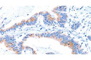 Immunohistochemistry of paraffin-embedded Human colon cancer tissue using SMG8 Polyclonal Antibody at dilution 1:50 (SMG8 Antikörper)