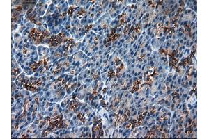 Immunohistochemical staining of paraffin-embedded Adenocarcinoma of colon using anti-KRT18 (ABIN2452646) mouse monoclonal antibody. (Cytokeratin 18 Antikörper  (AA 69-372))