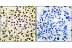 Immunohistochemistry analysis of paraffin-embedded human breast carcinoma tissue, using Fos Antibody. (c-FOS Antikörper  (AA 1-50))