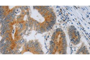 Immunohistochemistry of paraffin-embedded Human colon cancer using F2R Polyclonal Antibody at dilution of 1:40 (PAR1 Antikörper)