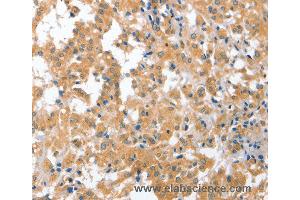 Immunohistochemistry of Human liver cancer using CDR2 Polyclonal Antibody at dilution of 1:60 (CDR2 Antikörper)