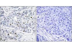 Immunohistochemistry analysis of paraffin-embedded human breast carcinoma tissue, using Retinoblastoma (Ab-821) Antibody. (Retinoblastoma Protein (Rb) Antikörper  (AA 791-840))