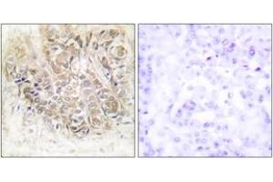 Immunohistochemistry analysis of paraffin-embedded human breast carcinoma tissue, using TCTP Antibody. (TPT1 Antikörper  (AA 71-120))