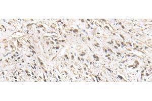 Immunohistochemistry of paraffin-embedded Human prost ate cancer tissue using ZNF281 Polyclonal Antibody at dilution of 1:30(x200) (ZNF281 Antikörper)