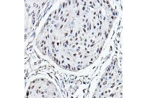 Immunohistochemistry of paraffin-embedded human esophageal cancer using MDC1 Rabbit pAb (ABIN6134688, ABIN6143659, ABIN6143661 and ABIN6216452) at dilution of 1:150 (40x lens). (MDC1 Antikörper  (AA 1-100))
