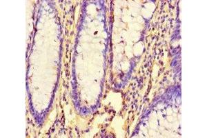 Immunohistochemistry of paraffin-embedded human colon cancer using ABIN7154592 at dilution of 1:100
