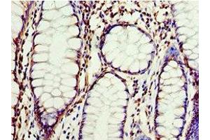 Immunohistochemistry of paraffin-embedded human colon cancer using ABIN7147915 at dilution of 1:100