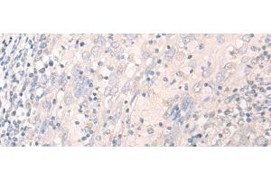 Immunohistochemistry of paraffin-embedded Human cervical cancer tissue using LILRA2 Polyclonal Antibody at dilution of 1:40(x200) (LILRA2 Antikörper)