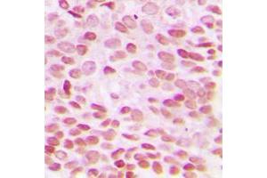 Immunohistochemical analysis of GADD153 staining in human breast cancer formalin fixed paraffin embedded tissue section. (DDIT3 Antikörper  (N-Term))