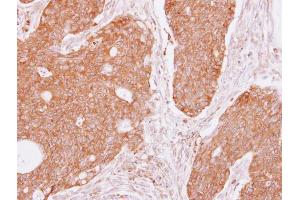 IHC-P Image DIAPH1 antibody [C2C3], C-term detects DIAPH1 protein at cytoplasm on human colon carcinoma by immunohistochemical analysis. (DIAPH1 Antikörper  (C-Term))