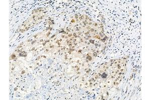 Phospho-Histone H3 (Thr3) Antibody at 1/100 staining Human ovarian cancer by IHC-P.
