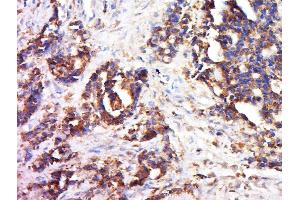 Paraformaldehyde-fixed, paraffin embedded human colon cancer, Antigen retrieval by boiling in sodium citrate buffer (pH6) for 15min, Block endogenous peroxidase by 3% hydrogen peroxide for 30 minutes, Blocking buffer (normal goat serum) at 37°C for 20min, Antibody incubation with Collagen III Polyclonal Antibody, Unconjugated  at 1:200 overnight at 4°C, followed by a conjugated secondary and DAB staining. (COL3 Antikörper  (AA 801-900))