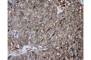 Immunohistochemical staining of paraffin-embedded Adenocarcinoma of ovary tissue using anti-PRKAR2A mouse monoclonal antibody. (PRKAR2A Antikörper)