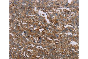 Immunohistochemistry of Human liver cancer using GCK Polyclonal Antibody at dilution of 1:40