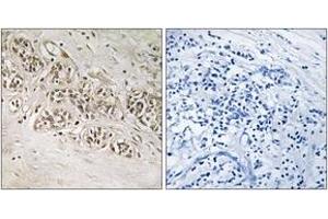 Immunohistochemistry analysis of paraffin-embedded human breast carcinoma, using RAD54B Antibody.