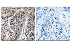 Immunohistochemical analysis of paraffin-embedded human breast carcinoma tissue, using p130 Cas (Phospho-Tyr410) antibody (left)or the same antibody preincubated with blocking peptide (right). (BCAR1 Antikörper  (pTyr410))