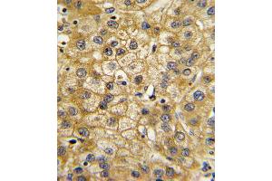 Formalin-fixed and paraffin-embedded human hepatocarcinoma with ADIPOR1 Antibody , which was peroxidase-conjugated to the secondary antibody, followed by DAB staining. (Adiponectin Receptor 1 Antikörper  (C-Term))