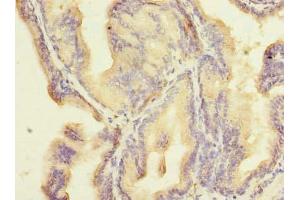 Immunohistochemistry of paraffin-embedded human prostate cancer using ABIN7176433 at dilution of 1:100 (ZNF614 Antikörper  (AA 1-198))