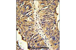 Formalin-fixed and paraffin-embedded human lung carcinoma reacted with PDIA3 Antibody , which was peroxidase-conjugated to the secondary antibody, followed by DAB staining. (PDIA3 Antikörper  (AA 192-220))