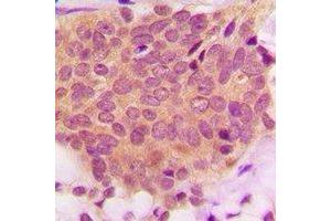 Immunohistochemical analysis of Ezrin/Radixin/Moesin  staining in human breast cancer formalin fixed paraffin embedded tissue section.